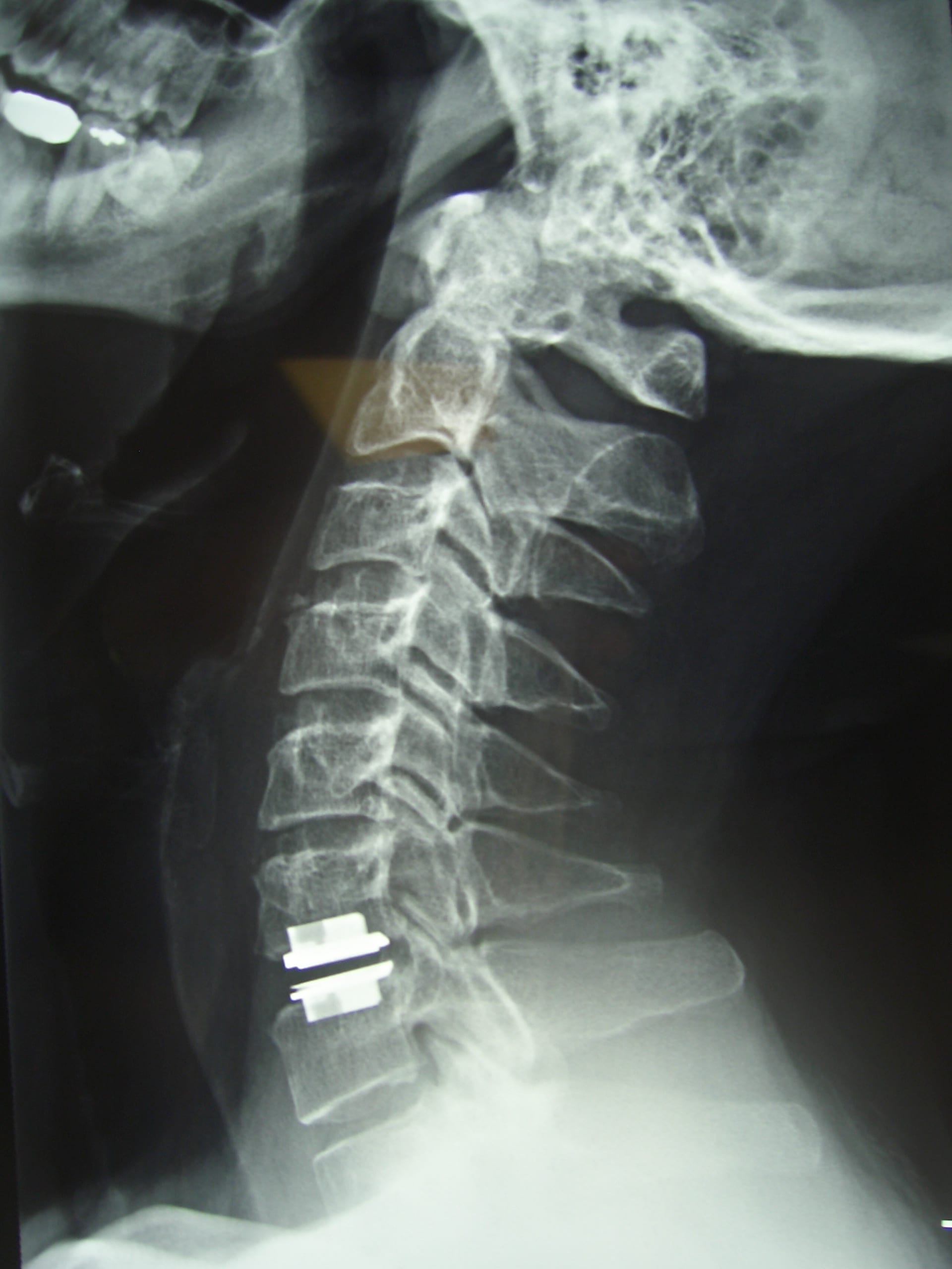 Cervical Disc Replacement Specialist Sydney Dr Timothy Steel
